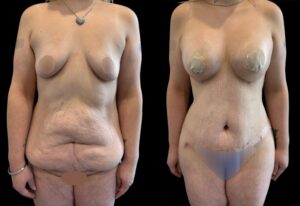Abdominoplastie